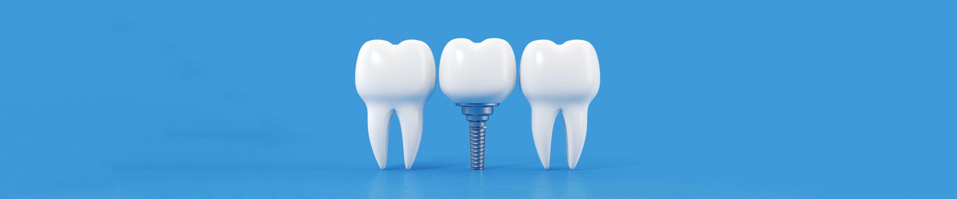all-on-4-all-on-6-dental-implant