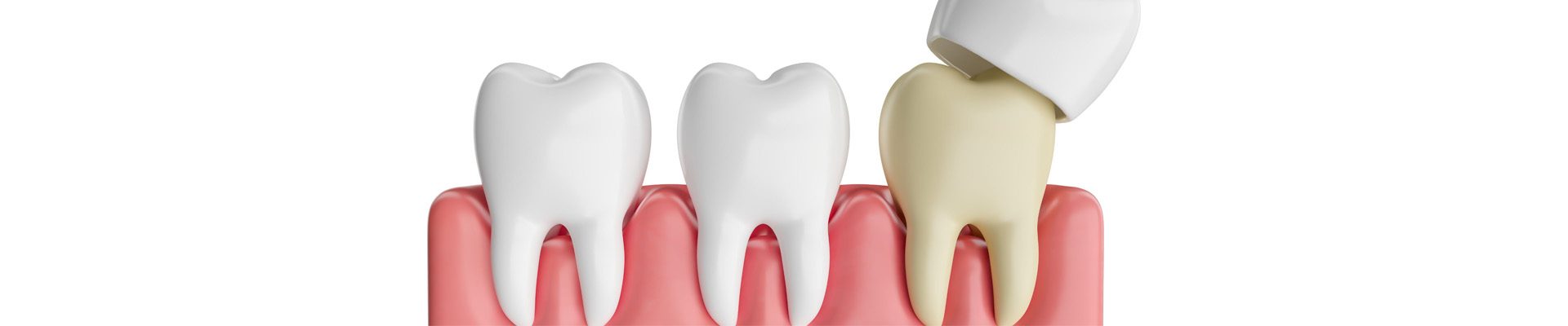 dental-crowns
