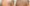 hair-transplant-1200x675
