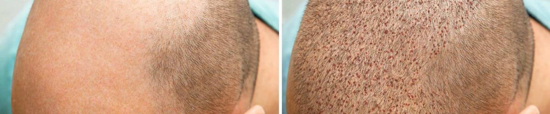 hair-transplant-1200x675