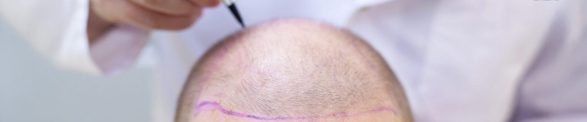 sapphire-fue-hair-transplant