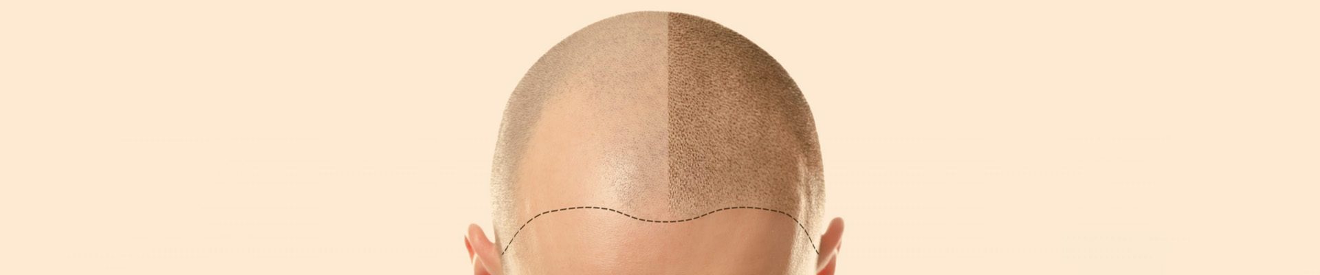 scalp-micropigmentation